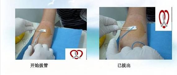 picc置管的这5点你都知道了吗?-乳腺癌康复圈-觅健