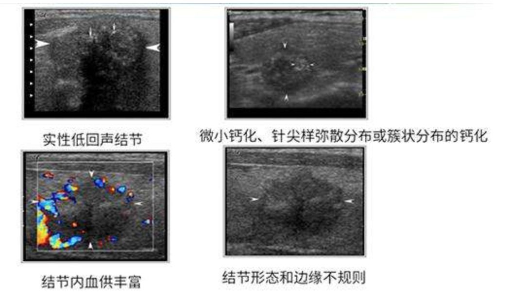 甲状腺超声报告分级解读哪些是甲状腺结节恶性超声征象