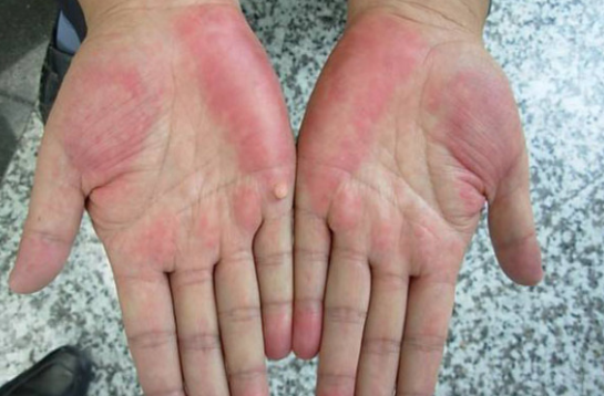 手掌上出现如同朱砂样的红色,是肝病的外露,也叫肝掌,这是肝肿大的