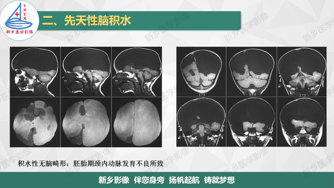 神经系统先天性畸形及发育异常影像解读一