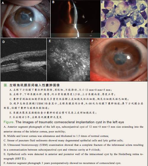 【头条】外伤性角膜,巩膜层间上皮植入性囊肿