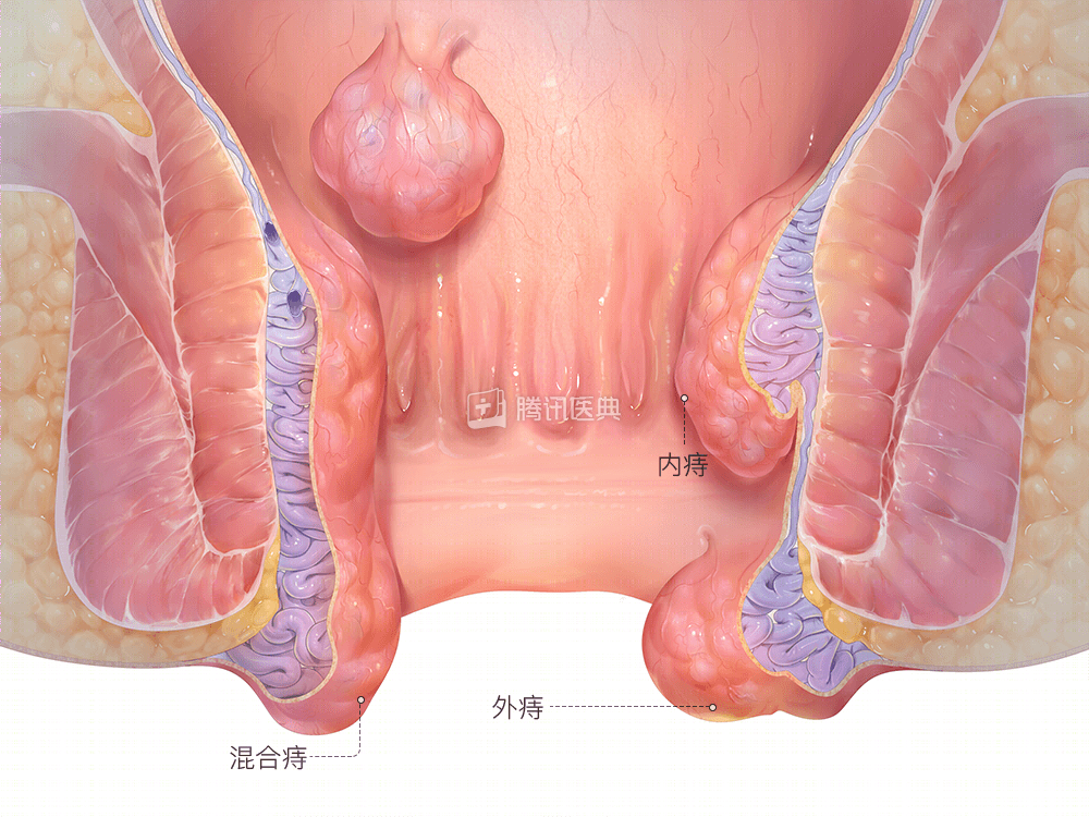 主要临床表现为内痔和外痔的症状同时存在,严重时表现为环状痔脱出