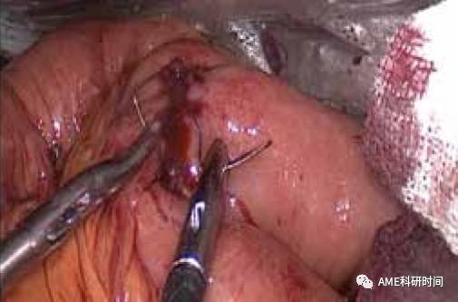 管型吻合器怎么用完全腹腔镜下全胃切除术后的消化道重建——7种食管空肠吻合方法_https://www.jmylbn.com_新闻资讯_第40张