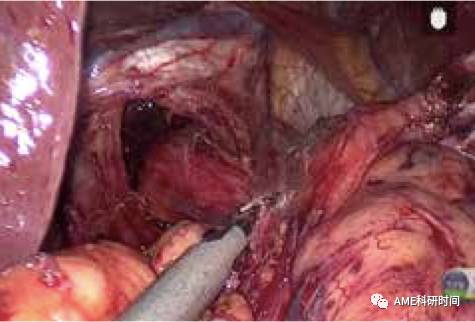 管型吻合器怎么用完全腹腔镜下全胃切除术后的消化道重建——7种食管空肠吻合方法_https://www.jmylbn.com_新闻资讯_第20张