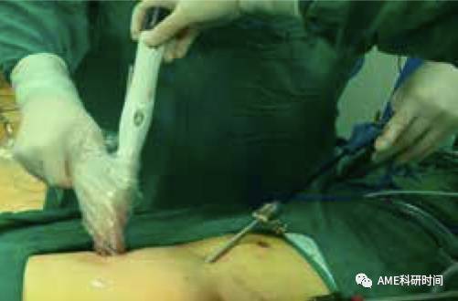 管型吻合器怎么用完全腹腔镜下全胃切除术后的消化道重建——7种食管空肠吻合方法_https://www.jmylbn.com_新闻资讯_第33张