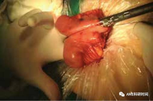 管型吻合器怎么用完全腹腔镜下全胃切除术后的消化道重建——7种食管空肠吻合方法_https://www.jmylbn.com_新闻资讯_第41张