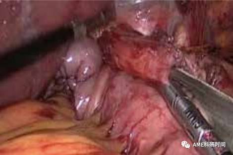 管型吻合器怎么用完全腹腔镜下全胃切除术后的消化道重建——7种食管空肠吻合方法_https://www.jmylbn.com_新闻资讯_第46张