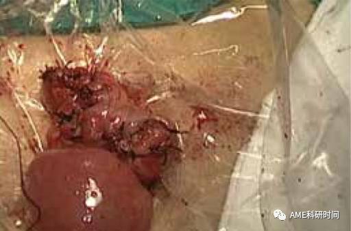 管型吻合器怎么用完全腹腔镜下全胃切除术后的消化道重建——7种食管空肠吻合方法_https://www.jmylbn.com_新闻资讯_第42张