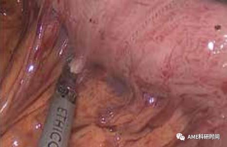 管型吻合器怎么用完全腹腔镜下全胃切除术后的消化道重建——7种食管空肠吻合方法_https://www.jmylbn.com_新闻资讯_第31张