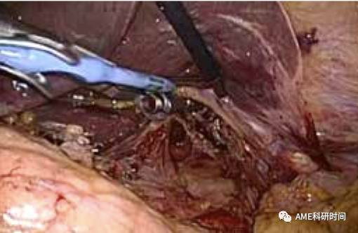 管型吻合器怎么用完全腹腔镜下全胃切除术后的消化道重建——7种食管空肠吻合方法_https://www.jmylbn.com_新闻资讯_第18张