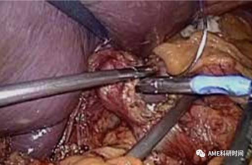管型吻合器怎么用完全腹腔镜下全胃切除术后的消化道重建——7种食管空肠吻合方法_https://www.jmylbn.com_新闻资讯_第15张