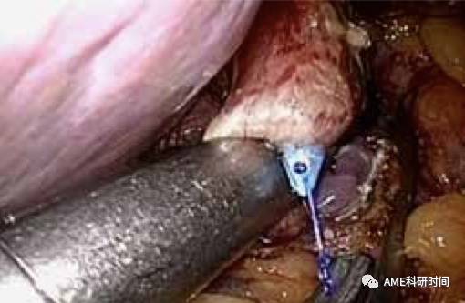 管型吻合器怎么用完全腹腔镜下全胃切除术后的消化道重建——7种食管空肠吻合方法_https://www.jmylbn.com_新闻资讯_第17张