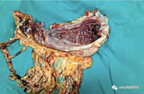 管型吻合器怎么用完全腹腔镜下全胃切除术后的消化道重建——7种食管空肠吻合方法_https://www.jmylbn.com_新闻资讯_第53张