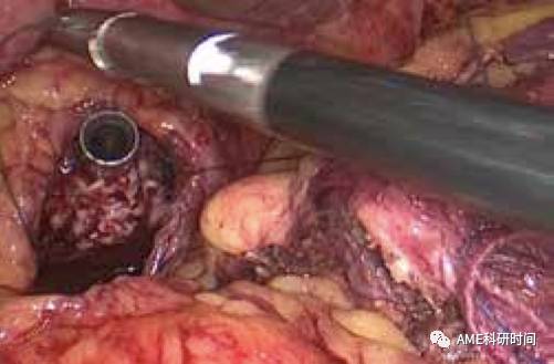 管型吻合器怎么用完全腹腔镜下全胃切除术后的消化道重建——7种食管空肠吻合方法_https://www.jmylbn.com_新闻资讯_第28张