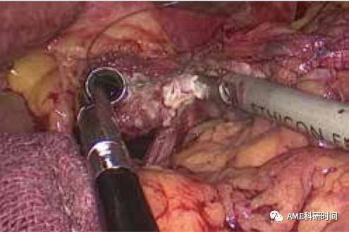 管型吻合器怎么用完全腹腔镜下全胃切除术后的消化道重建——7种食管空肠吻合方法_https://www.jmylbn.com_新闻资讯_第26张