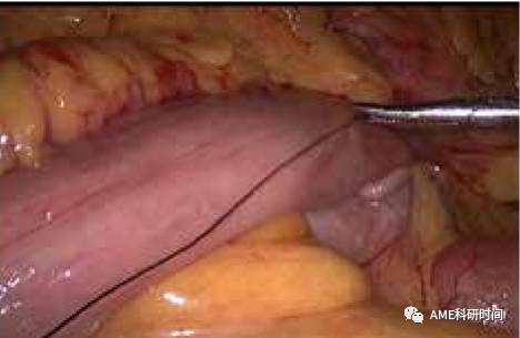 管型吻合器怎么用完全腹腔镜下全胃切除术后的消化道重建——7种食管空肠吻合方法_https://www.jmylbn.com_新闻资讯_第29张