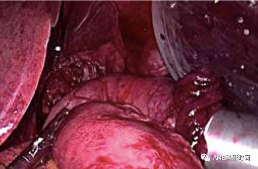 管型吻合器怎么用完全腹腔镜下全胃切除术后的消化道重建——7种食管空肠吻合方法_https://www.jmylbn.com_新闻资讯_第36张