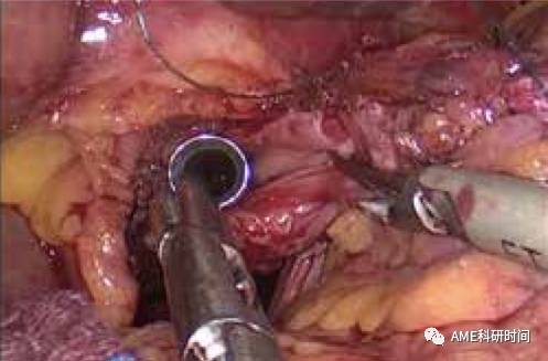 管型吻合器怎么用完全腹腔镜下全胃切除术后的消化道重建——7种食管空肠吻合方法_https://www.jmylbn.com_新闻资讯_第25张