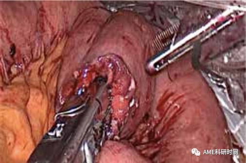 管型吻合器怎么用完全腹腔镜下全胃切除术后的消化道重建——7种食管空肠吻合方法_https://www.jmylbn.com_新闻资讯_第39张