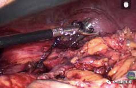 管型吻合器怎么用完全腹腔镜下全胃切除术后的消化道重建——7种食管空肠吻合方法_https://www.jmylbn.com_新闻资讯_第22张