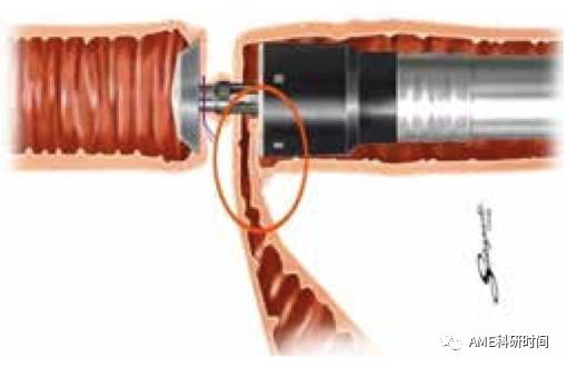 管型吻合器怎么用完全腹腔镜下全胃切除术后的消化道重建——7种食管空肠吻合方法_https://www.jmylbn.com_新闻资讯_第37张