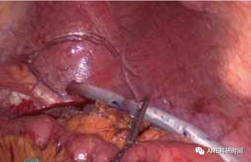 管型吻合器怎么用完全腹腔镜下全胃切除术后的消化道重建——7种食管空肠吻合方法_https://www.jmylbn.com_新闻资讯_第50张