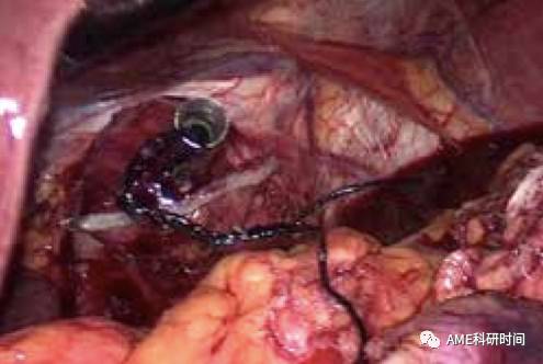 管型吻合器怎么用完全腹腔镜下全胃切除术后的消化道重建——7种食管空肠吻合方法_https://www.jmylbn.com_新闻资讯_第24张