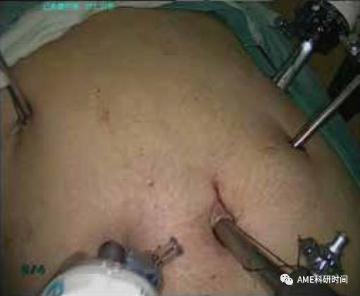 管型吻合器怎么用完全腹腔镜下全胃切除术后的消化道重建——7种食管空肠吻合方法_https://www.jmylbn.com_新闻资讯_第2张