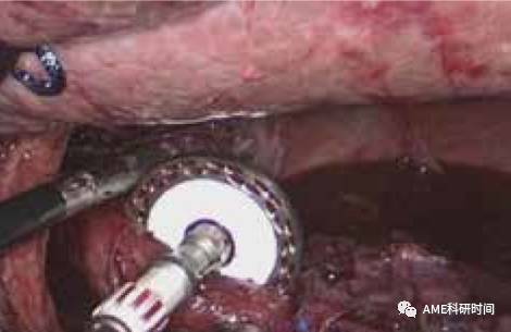 管型吻合器怎么用完全腹腔镜下全胃切除术后的消化道重建——7种食管空肠吻合方法_https://www.jmylbn.com_新闻资讯_第12张