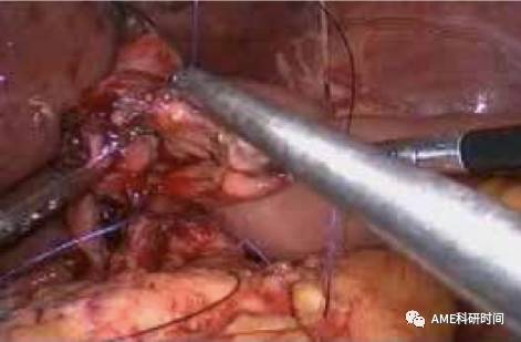 管型吻合器怎么用完全腹腔镜下全胃切除术后的消化道重建——7种食管空肠吻合方法_https://www.jmylbn.com_新闻资讯_第48张