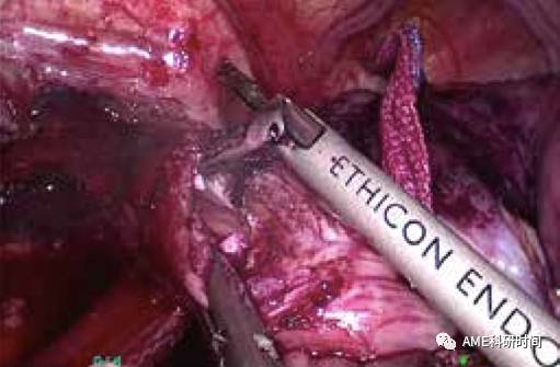 管型吻合器怎么用完全腹腔镜下全胃切除术后的消化道重建——7种食管空肠吻合方法_https://www.jmylbn.com_新闻资讯_第7张