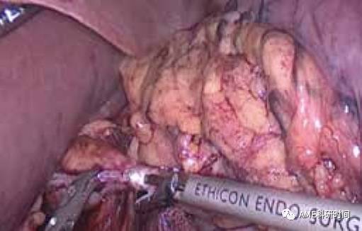 管型吻合器怎么用完全腹腔镜下全胃切除术后的消化道重建——7种食管空肠吻合方法_https://www.jmylbn.com_新闻资讯_第5张