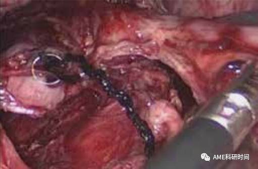 管型吻合器怎么用完全腹腔镜下全胃切除术后的消化道重建——7种食管空肠吻合方法_https://www.jmylbn.com_新闻资讯_第14张
