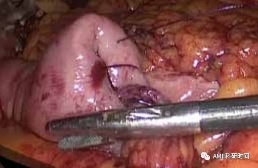 管型吻合器怎么用完全腹腔镜下全胃切除术后的消化道重建——7种食管空肠吻合方法_https://www.jmylbn.com_新闻资讯_第44张