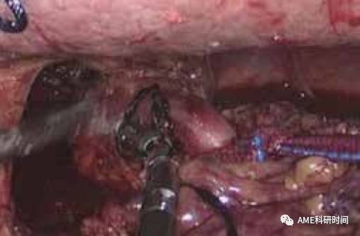管型吻合器怎么用完全腹腔镜下全胃切除术后的消化道重建——7种食管空肠吻合方法_https://www.jmylbn.com_新闻资讯_第13张