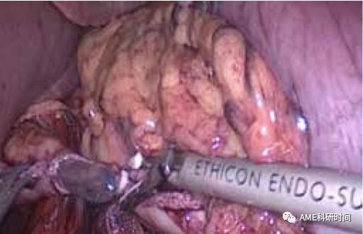 管型吻合器怎么用完全腹腔镜下全胃切除术后的消化道重建——7种食管空肠吻合方法_https://www.jmylbn.com_新闻资讯_第6张