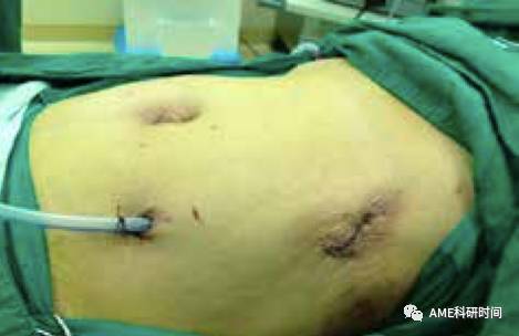 管型吻合器怎么用完全腹腔镜下全胃切除术后的消化道重建——7种食管空肠吻合方法_https://www.jmylbn.com_新闻资讯_第54张