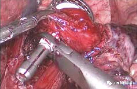 管型吻合器怎么用完全腹腔镜下全胃切除术后的消化道重建——7种食管空肠吻合方法_https://www.jmylbn.com_新闻资讯_第9张