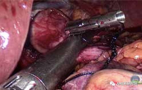 管型吻合器怎么用完全腹腔镜下全胃切除术后的消化道重建——7种食管空肠吻合方法_https://www.jmylbn.com_新闻资讯_第23张