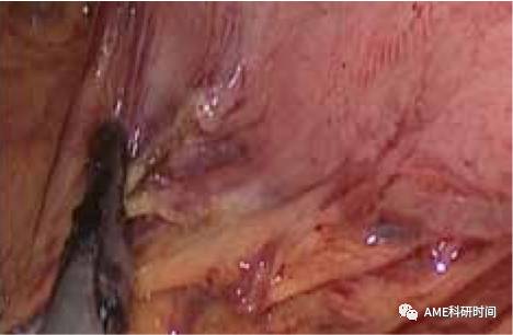 管型吻合器怎么用完全腹腔镜下全胃切除术后的消化道重建——7种食管空肠吻合方法_https://www.jmylbn.com_新闻资讯_第32张