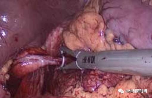 管型吻合器怎么用完全腹腔镜下全胃切除术后的消化道重建——7种食管空肠吻合方法_https://www.jmylbn.com_新闻资讯_第4张