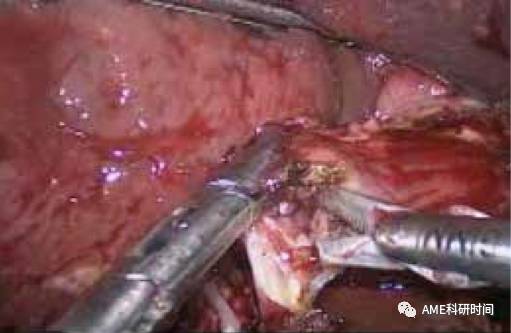 管型吻合器怎么用完全腹腔镜下全胃切除术后的消化道重建——7种食管空肠吻合方法_https://www.jmylbn.com_新闻资讯_第43张