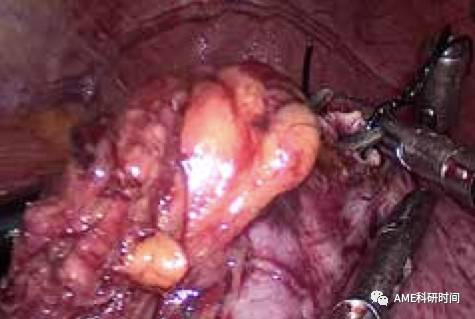 管型吻合器怎么用完全腹腔镜下全胃切除术后的消化道重建——7种食管空肠吻合方法_https://www.jmylbn.com_新闻资讯_第21张