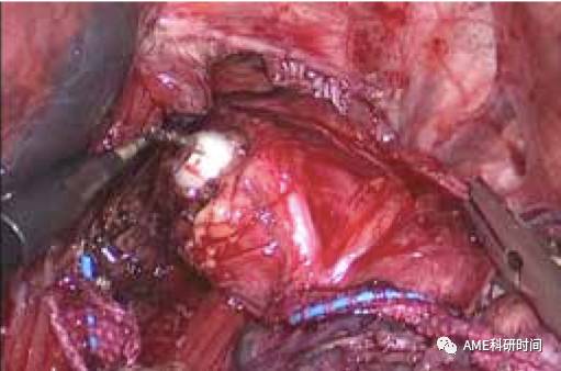 管型吻合器怎么用完全腹腔镜下全胃切除术后的消化道重建——7种食管空肠吻合方法_https://www.jmylbn.com_新闻资讯_第8张