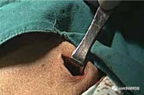 管型吻合器怎么用完全腹腔镜下全胃切除术后的消化道重建——7种食管空肠吻合方法_https://www.jmylbn.com_新闻资讯_第51张