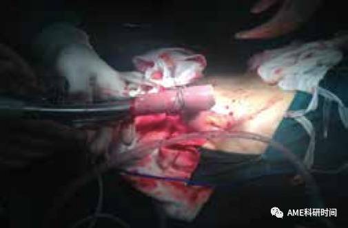 管型吻合器怎么用完全腹腔镜下全胃切除术后的消化道重建——7种食管空肠吻合方法_https://www.jmylbn.com_新闻资讯_第38张