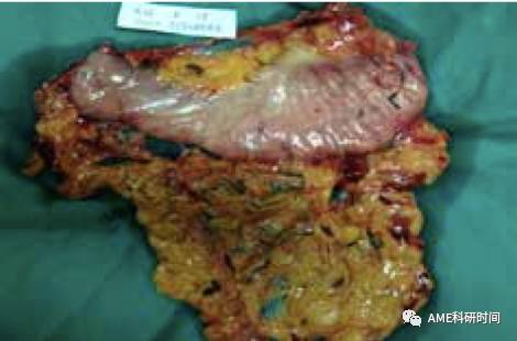 管型吻合器怎么用完全腹腔镜下全胃切除术后的消化道重建——7种食管空肠吻合方法_https://www.jmylbn.com_新闻资讯_第52张
