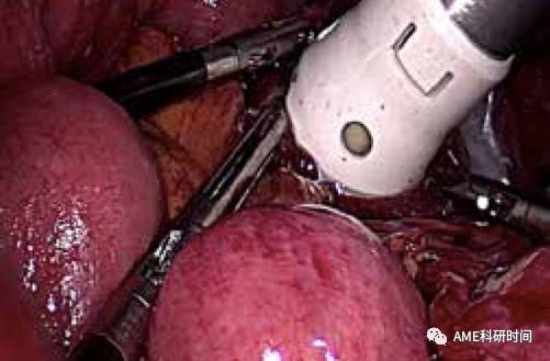 管型吻合器怎么用完全腹腔镜下全胃切除术后的消化道重建——7种食管空肠吻合方法_https://www.jmylbn.com_新闻资讯_第34张