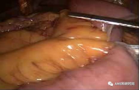 管型吻合器怎么用完全腹腔镜下全胃切除术后的消化道重建——7种食管空肠吻合方法_https://www.jmylbn.com_新闻资讯_第30张