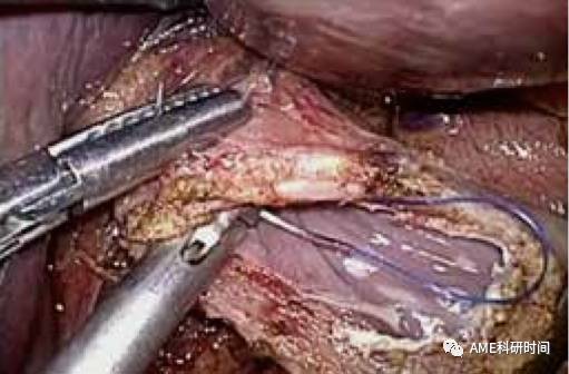 管型吻合器怎么用完全腹腔镜下全胃切除术后的消化道重建——7种食管空肠吻合方法_https://www.jmylbn.com_新闻资讯_第16张